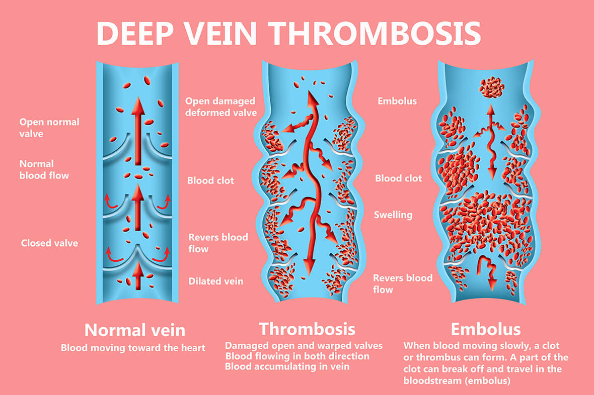 Thrombosis is the formation of a blood clot in a blood vessel. 