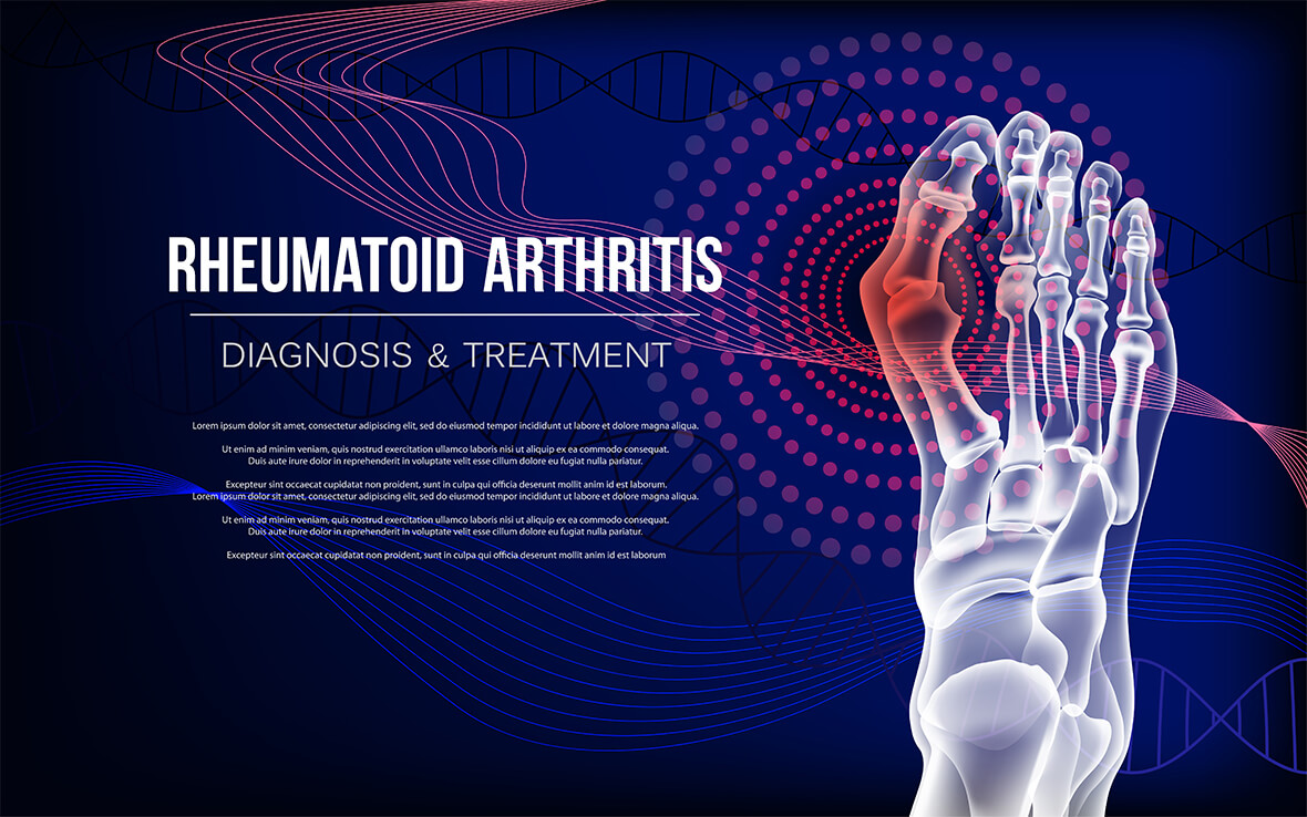 Rheumatoid arthritis (RA) is a chronic autoimmune disease that primarily affects the joints